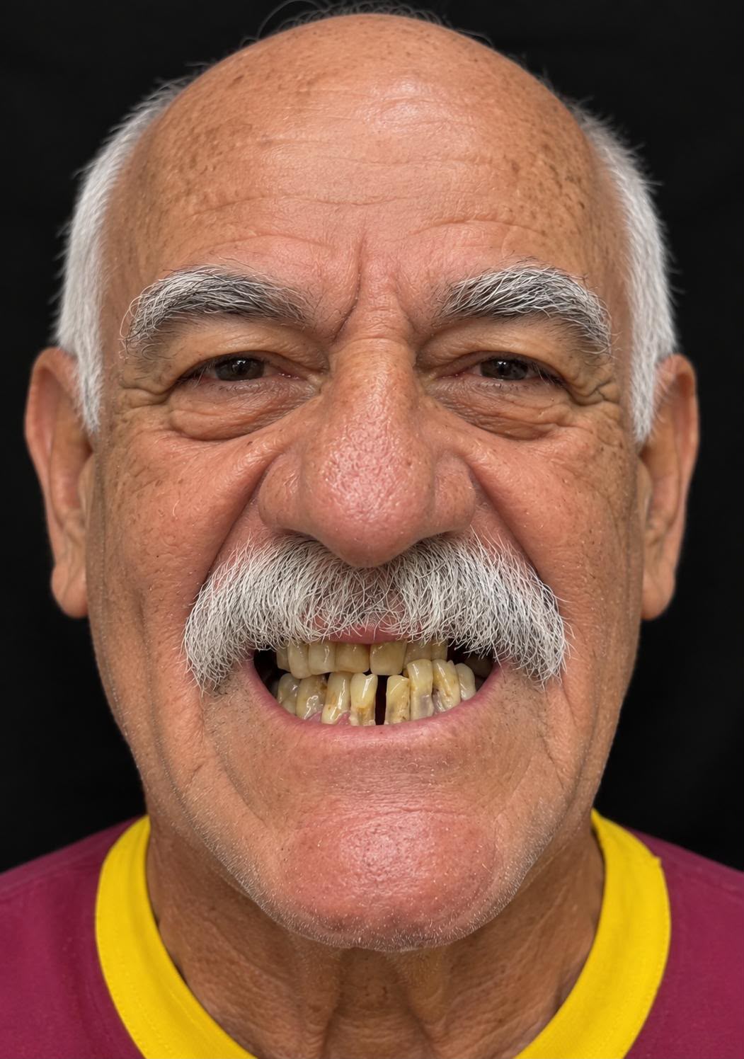 Transformación facial y de la sonrisa · antes