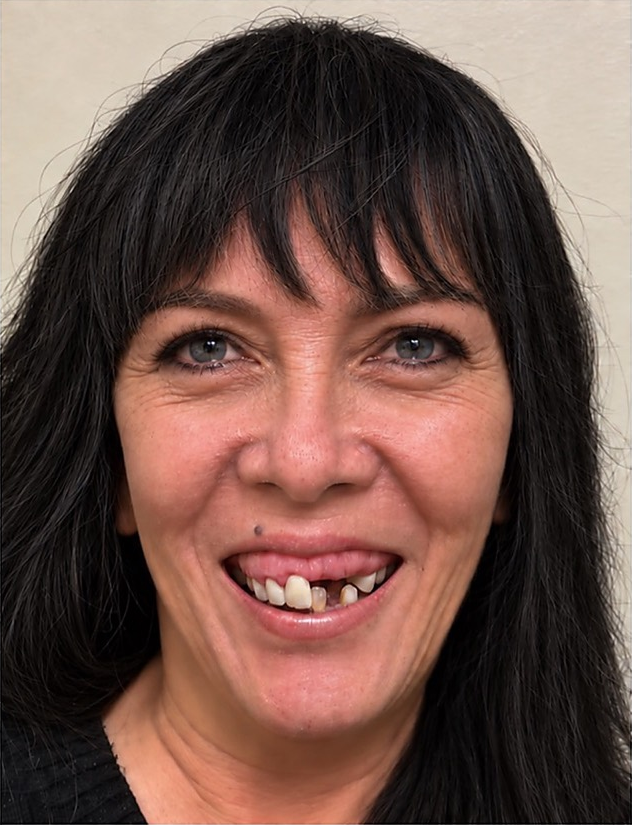 ¿Sonrisa gingival y dientes ausentes? · antes