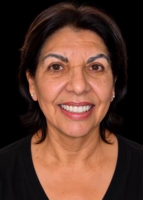 ¿Te han dicho que no tienes suficiente hueso para implantes dentales? · después