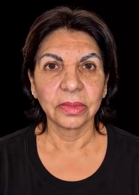¿Te han dicho que no tienes suficiente hueso para implantes dentales? · antes